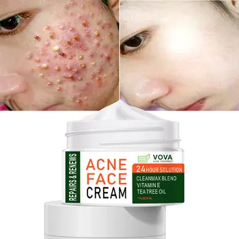 Ефективен Крем за премахване на акне Herbal Acne Spots Oil Control Крем против акне за грижа за кожата Избелващ Хидратиращ Гел за лице за грижа за кожата, 30 г